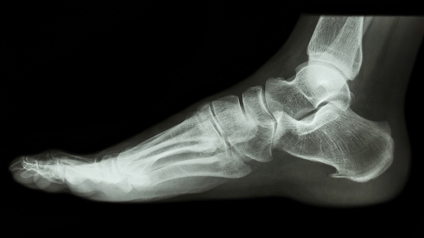 Fersensporn (Fasziitis plantaris)